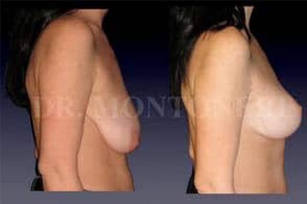 augmentation-mammaire-seins-chirurgie-ses-seins-mammaire-paris-avant-apres-chirurgien-esthetique-plasticien-paris-dr-sebastiano-montoneri-b