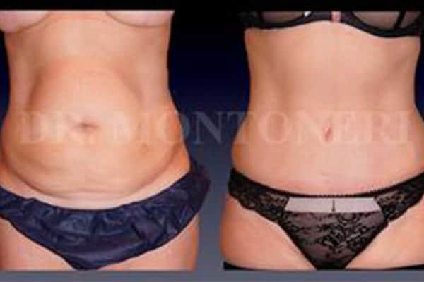 avant-apres-abdominoplastie-chirurgie-ventre-plat-operation-chirurgie-de-la-silouhette-paris-chirurgien-plasticien-paris-docteur-sebastiano-montoneri