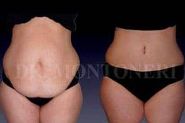 avant-apres-operation-mini-plastie-tablier-abdominale-ventre-chirurgie-de-la-silouhette-paris-chirurgien-plasticien-paris-docteur-sebastiano-montoneri