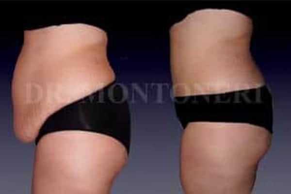 avant-apres-plastie-abominale-ventre-chirurgie-de-la-silouhette-paris-chirurgien-plasticien-paris-docteur-sebastiano-montoneri