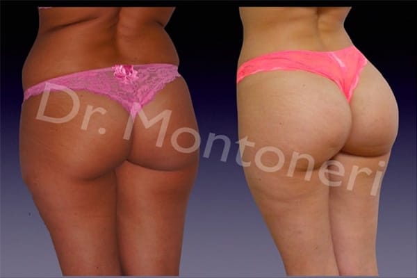 chirurgie-fesses-avant-apres-f