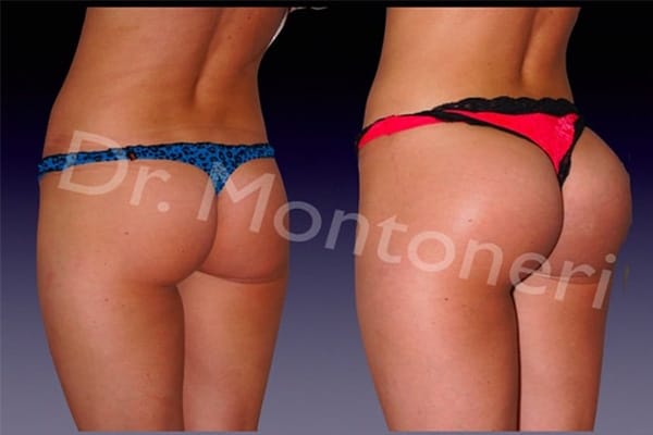 chirurgie-fesses-avant-apres-h