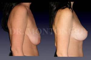 chirurgie-reduction-mammaire-chirurgie-et-medecine-esthetique-dr-sebastiano-montoneri-chirurgien-esthetique-paris-16
