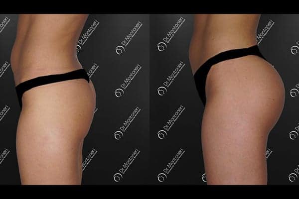 implants-fessiers-prothese-fesse-avant-apres-paris-chirurgie-des-fesses-fessier-paris-chirurgien-esthetique-plasticien-paris-docteur-montoneri-b