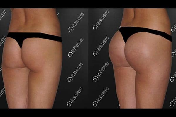 implants-fessiers-prothese-fesse-avant-apres-paris-chirurgie-des-fesses-fessier-paris-chirurgien-esthetique-plasticien-paris-docteur-sebastiano-montoneri-a