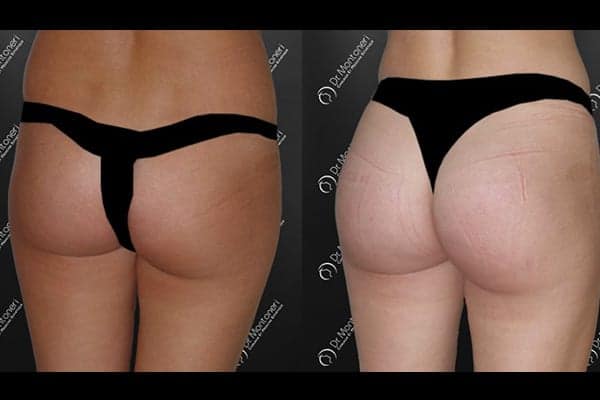 implants-fessiers-prothese-fesse-avant-apres-paris-chirurgie-des-fesses-fessier-paris-chirurgien-esthetique-plasticien-paris-docteur-sebastiano-montoneri-d