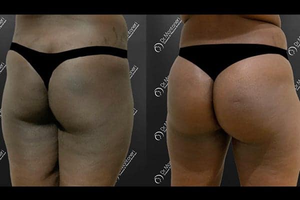 implants-fessiers-prothese-fesse-avant-apres-paris-chirurgie-des-fesses-fessier-paris-chirurgien-esthetique-plasticien-paris-docteur-sebastiano-montoneri-f