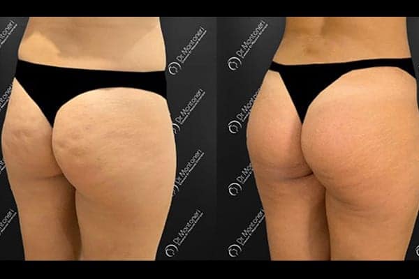 implants-fessiers-prothese-fesse-avant-apres-paris-chirurgie-des-fesses-fessier-paris-chirurgien-esthetique-plasticien-paris-docteur-sebastiano-montoneri-h