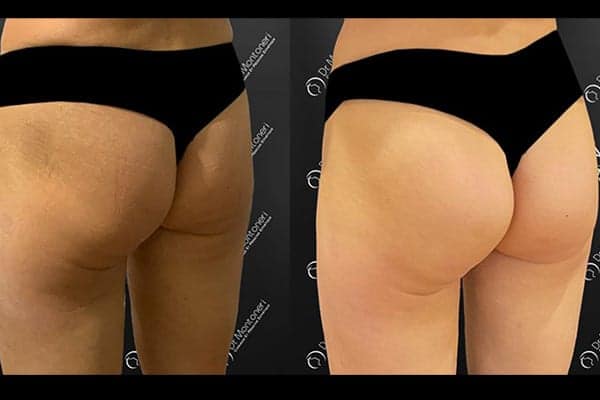 implants-fessiers-prothese-fesse-avant-apres-paris-chirurgie-des-fesses-fessier-paris-chirurgien-esthetique-plasticien-paris-dr-montoneri-g
