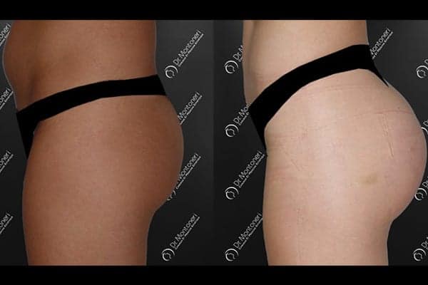 implants-fessiers-prothese-fesse-avant-apres-paris-chirurgie-des-fesses-fessier-paris-chirurgien-esthetique-plasticien-paris-dr-sebastiano-montoneri-c