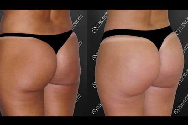 implants-fessiers-prothese-fesse-avant-apres-paris-chirurgie-des-fesses-fessier-paris-chirurgien-esthetique-plasticien-paris-dr-sebastiano-montoneri-e