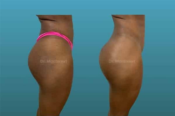 injection-acide-hyaluronique-correction-des-cernes-avant-apres-injection-acide-hyaluronique-visage-paris-medecine-esthetique-paris-chirurgien-esthetique-plasticien-dr-sebastiano-montoneri-a (1)