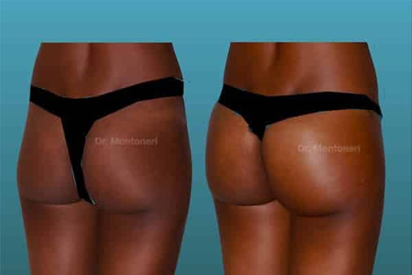 injection-acide-hyaluronique-correction-des-cernes-avant-apres-injection-acide-hyaluronique-visage-paris-medecine-esthetique-paris-chirurgien-esthetique-plasticien-dr-sebastiano-montoneri-b