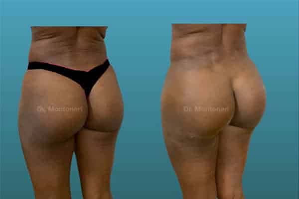 injection-acide-hyaluronique-correction-des-cernes-avant-apres-injection-acide-hyaluronique-visage-paris-medecine-esthetique-paris-chirurgien-esthetique-plasticien-dr-sebastiano-montoneri-c