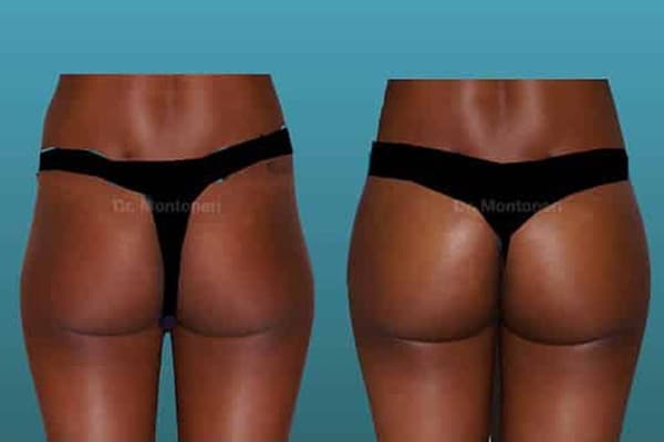 injection-acide-hyaluronique-correction-des-cernes-avant-apres-injection-acide-hyaluronique-visage-paris-medecine-esthetique-paris-chirurgien-esthetique-plasticien-dr-sebastiano-montoneri-d