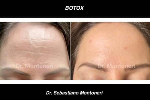 injection-botox-front-avant-apres-medecin-esthetique-paris-docteur-montoneri