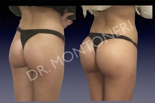 injections-fessiers-macrolane-acide-hyaluronique-avant-apres-chirurgie-des-fesses-fessier-chirurgien-esthetique-plasticien-paris-docteur-montoneri-b