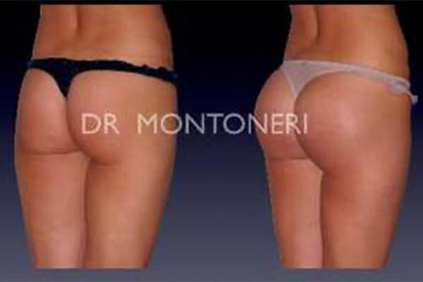 injections-fessiers-macrolane-acide-hyaluronique-avant-apres-chirurgie-des-fesses-fessier-chirurgien-esthetique-plasticien-paris-docteur-montoneri-e-1