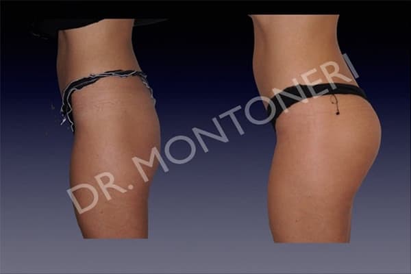 injections-fessiers-macrolane-acide-hyaluronique-avant-apres-chirurgie-des-fesses-fessier-chirurgien-esthetique-plasticien-paris-docteur-sebastiano-montoneri-f