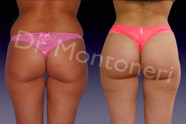 injections-fessiers-macrolane-acide-hyaluronique-avant-apres-chirurgie-des-fesses-fessier-chirurgien-esthetique-plasticien-paris-dr-montoneri-a