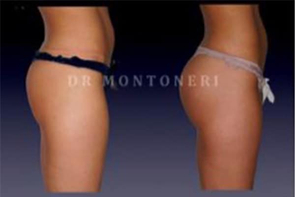 injections-fessiers-macrolane-acide-hyaluronique-avant-apres-chirurgie-des-fesses-fessier-chirurgien-esthetique-plasticien-paris-dr-montoneri-c