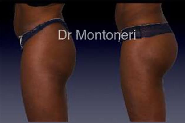 injections-fessiers-macrolane-acide-hyaluronique-avant-apres-chirurgie-des-fesses-fessier-chirurgien-esthetique-plasticien-paris-dr-montoneri-g