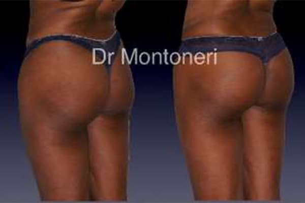 injections-fessiers-macrolane-acide-hyaluronique-avant-apres-chirurgie-des-fesses-fessier-chirurgien-esthetique-plasticien-paris-dr-sebastiano-montoneri-d (1)