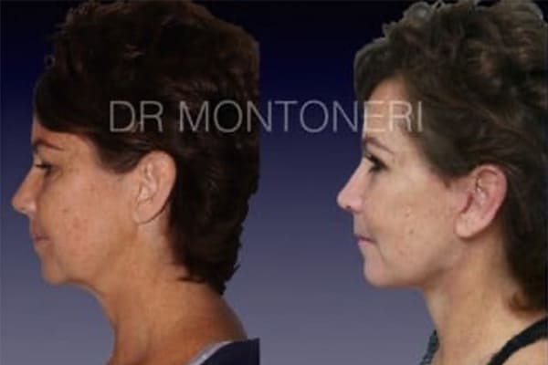 lifting-du-visage-cou-paris-avant-apres-a