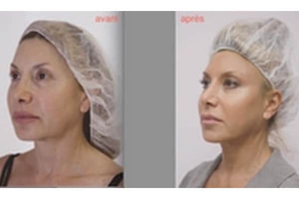 lifting-visage-sans-chirurgie-avant-apres-injection-acide-hyaluronique-botox-medecine-esthetique-paris-dr-sebastiano-montoneri-a
