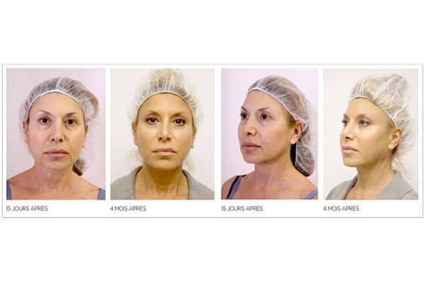 lifting-visage-sans-chirurgie-avant-apres-injection-acide-hyaluronique-botox-medecine-esthetique-paris-dr-sebastiano-montoneri-b