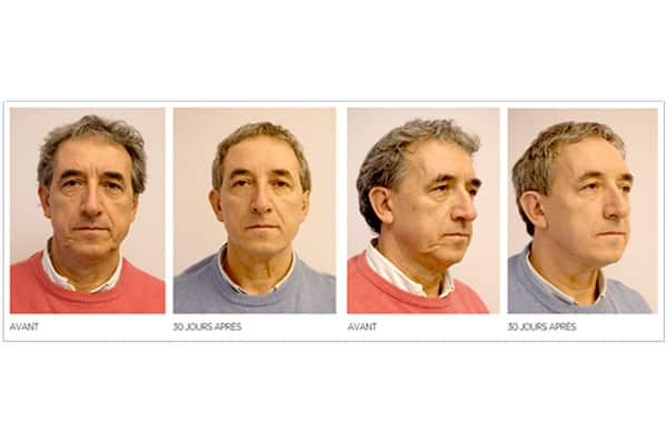 lifting-visage-sans-chirurgie-avant-apres-injection-acide-hyaluronique-botox-medecine-esthetique-paris-dr-sebastiano-montoneri-c