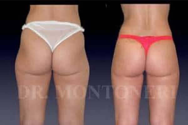 liposuccion-lipoaspiration-avant-apres-chirurgie-de-la-silouhette-paris-chirurgien-plasticien-paris-docteur-montoneri-a