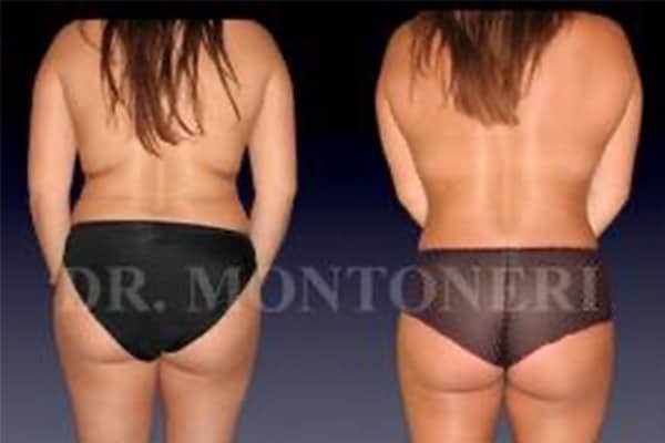 liposuccion-lipoaspiration-avant-apres-chirurgie-de-la-silouhette-paris-chirurgien-plasticien-paris-docteur-sebastiano-montoneri-b