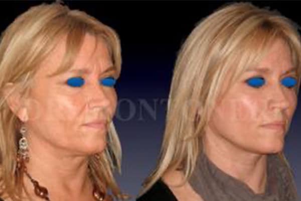 mini-lifting-visage-avant-apres