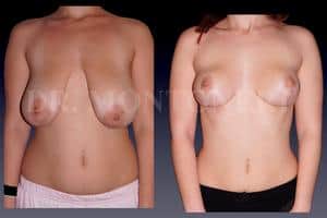 operation-reduction-mammaire-avant-apres-chirurgie-et-medecine-esthetique-dr-sebastiano-montoneri-chirurgien-esthetique-paris-16