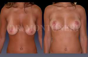 ptose-mammaire-lifting-des-seins-avant-apres-chirurgie-et-medecine-esthetique-dr-sebastiano-montoneri-chirurgien-esthetique-paris-16