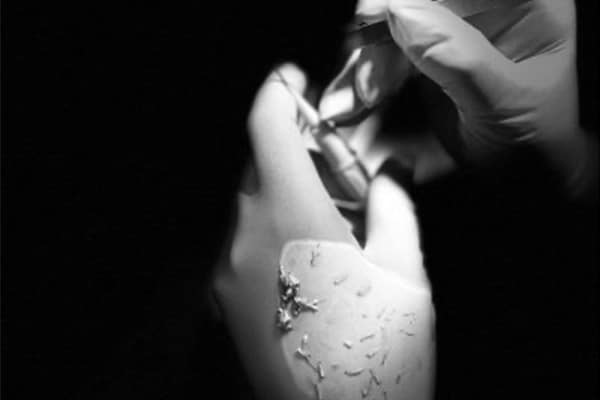 punch-line-hybride-paris-greffe-de-cheveux-fue-avant-apres-implant-capillaire-chirurgien-esthetique-paris-dr-sebastiano-montoneri