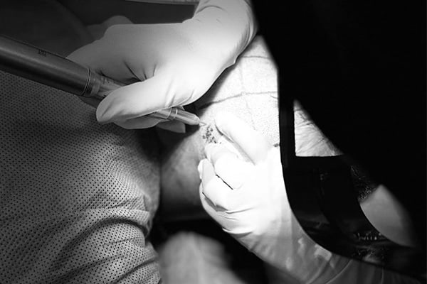 punch-line-hybride-paris-greffe-de-cheveux-fue-implant-capillaire-avant-apres-paris-chirurgien-esthetique-paris-dr-sebastiano-montoneri