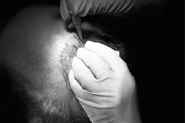 punch-line-hybride-paris-greffe-de-cheveux-tarif-paris-chirurgien-plasticien-paris-dr-montoneri