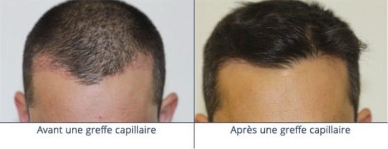 robot-artas-greffe-de-cheveux-implant-capillaire-paris-chirurgien-esthetique-plasticien-paris-dr-sebastiano-montoneri-avant-apres-a