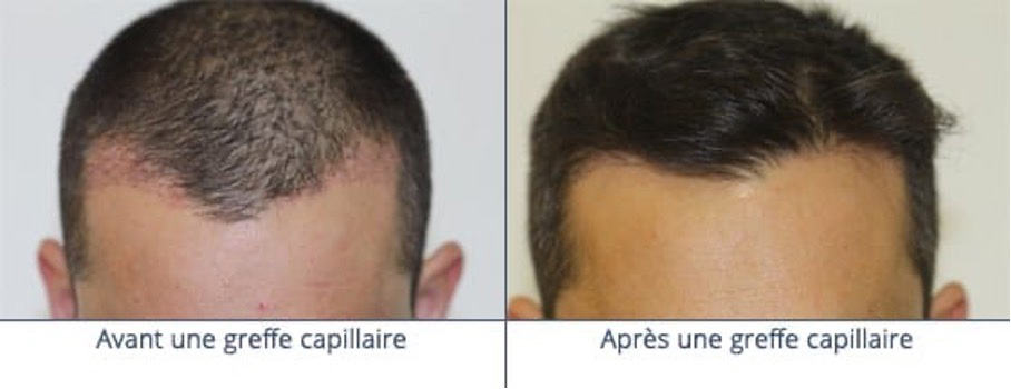 robot-artas-greffe-de-cheveux-implant-capillaire-paris-chirurgien-esthetique-plasticien-paris-dr-sebastiano-montoneri-avant-apres-a