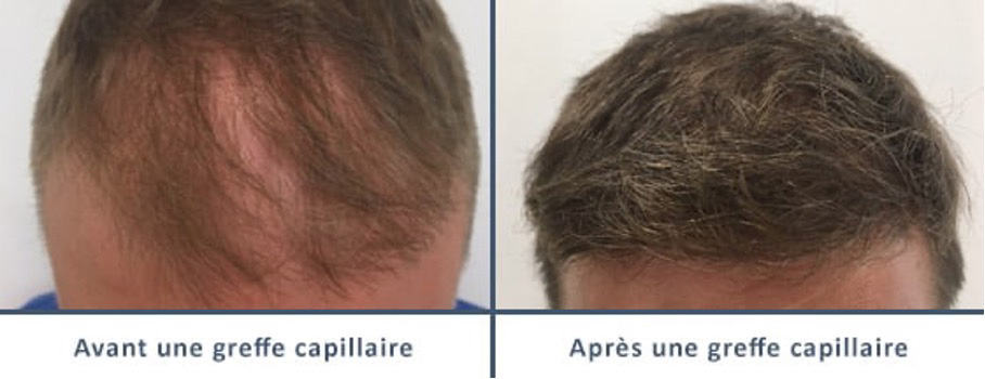 robot-artas-greffe-de-cheveux-implant-capillaire-paris-chirurgien-esthetique-plasticien-paris-dr-sebastiano-montoneri-avant-apres-b