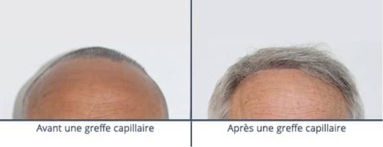 robot-artas-greffe-de-cheveux-implant-capillaire-paris-chirurgien-esthetique-plasticien-paris-dr-sebastiano-montoneri-avant-apres-c