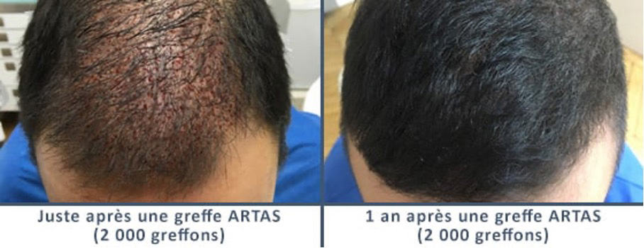 robot-artas-greffe-de-cheveux-implant-capillaire-paris-chirurgien-esthetique-plasticien-paris-dr-sebastiano-montoneri-avant-apres-d