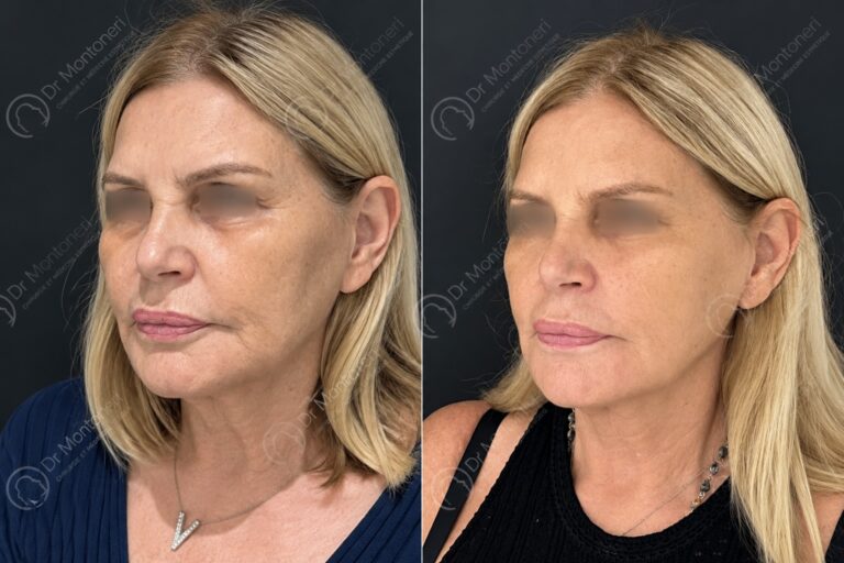 Confronto prima e dopo lifting del viso con fili di trazione permanenti su paziente donna – Dr Sebastiano Montoneri, Catania