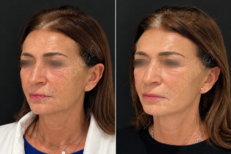 Prima e dopo lifting del viso con fili di trazione permanenti a Catania – Dr Sebastiano Montoneri
